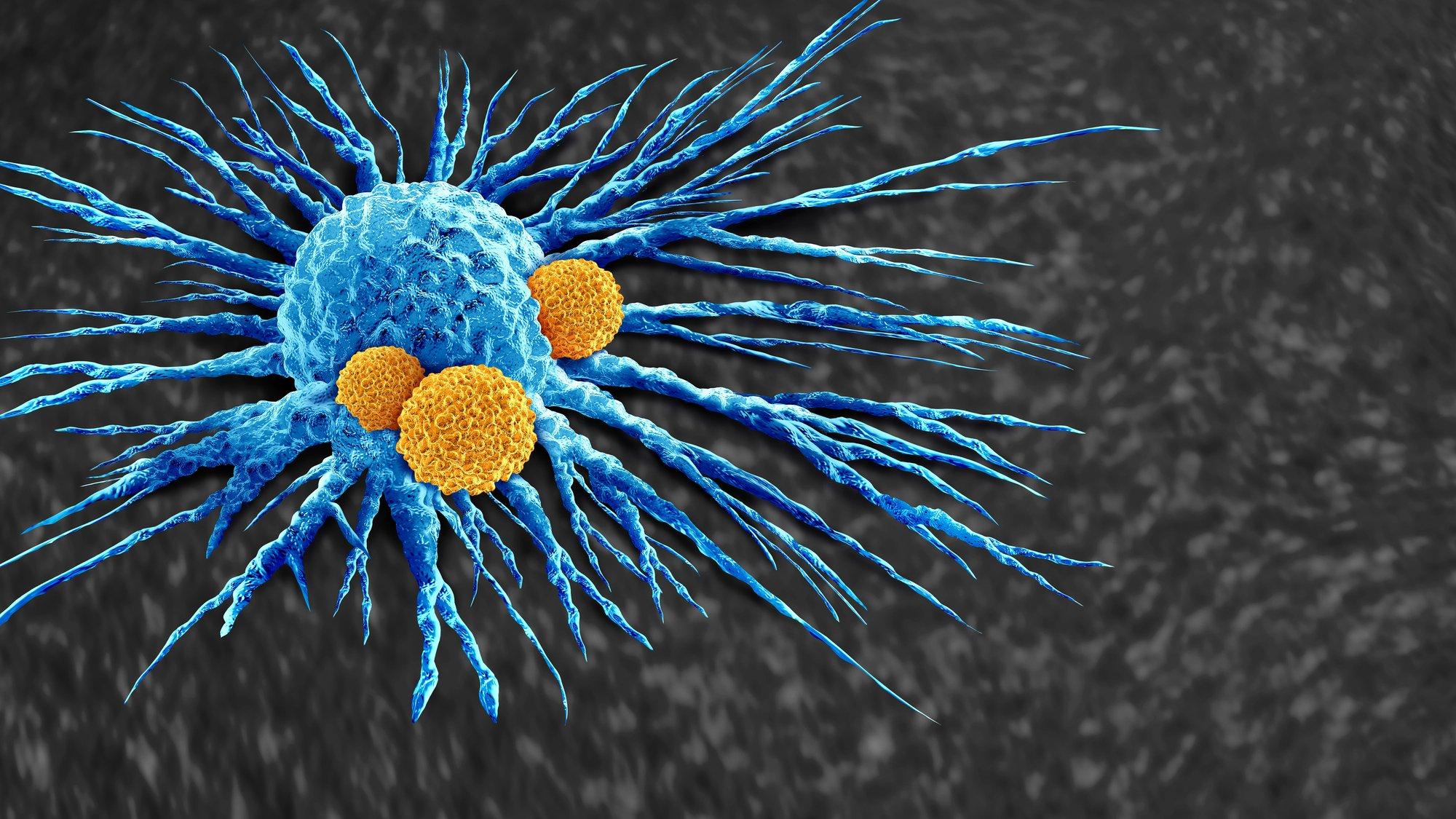 Mikroskopische Aufnahme einer Tumorzelle (blau) mit Immunzellen (orange).