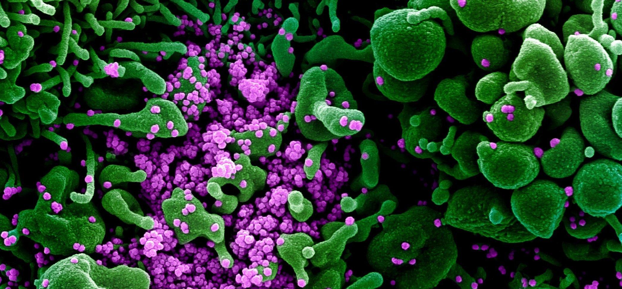 Ein Gewebe mit grün eingefärbten Körperzellen. Darauf sitzen teils eine große Zahl kleiner pinkfarbener Kügelchen. Dabei handelt es sich um das neue Coronavirus. Das Bild wurde nachträglich eingefärbt.