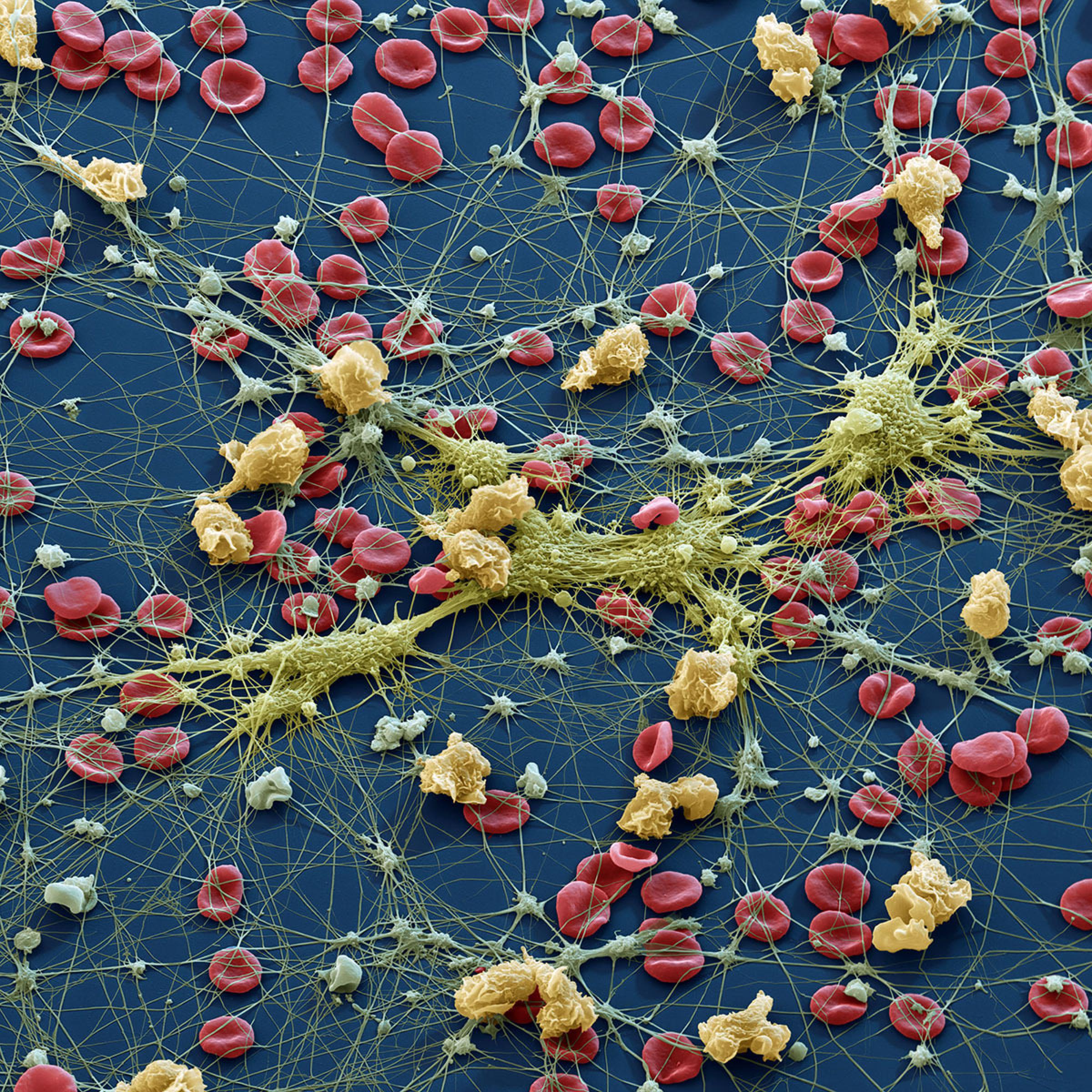 Medizin, Blut: Erythrozyten, Lymphozyten und Thrombozyten. Das Bild zeigt die wichtigsten Blutzellen: Die Erythrozyten (Rote Blutkörperchen) sorgen fur den Sauerstoff-Transport im Körper. Die Thrombozyten ( Blutplättchen, grau) werden wie die Ery's im Knochenmark gebildet und steuern durch Abgabe ihrer „Plättchenfaktoren“ die Blutgerinnung. Leukozyten (Weisse Blutkörperchen, beige+ gelbgrün)  sind im Körper für die Immunabwehr verantwortlich. Auf dem Bild haben einige weisse Blutzellen (Monozyten) Pseudopodien ausgebildet, andere (Granulozyten, gelblich gefärbt) haben Ihre kugelige Form erhalten. Raster-Elektronenmikroskop, Vergrößerung 960x