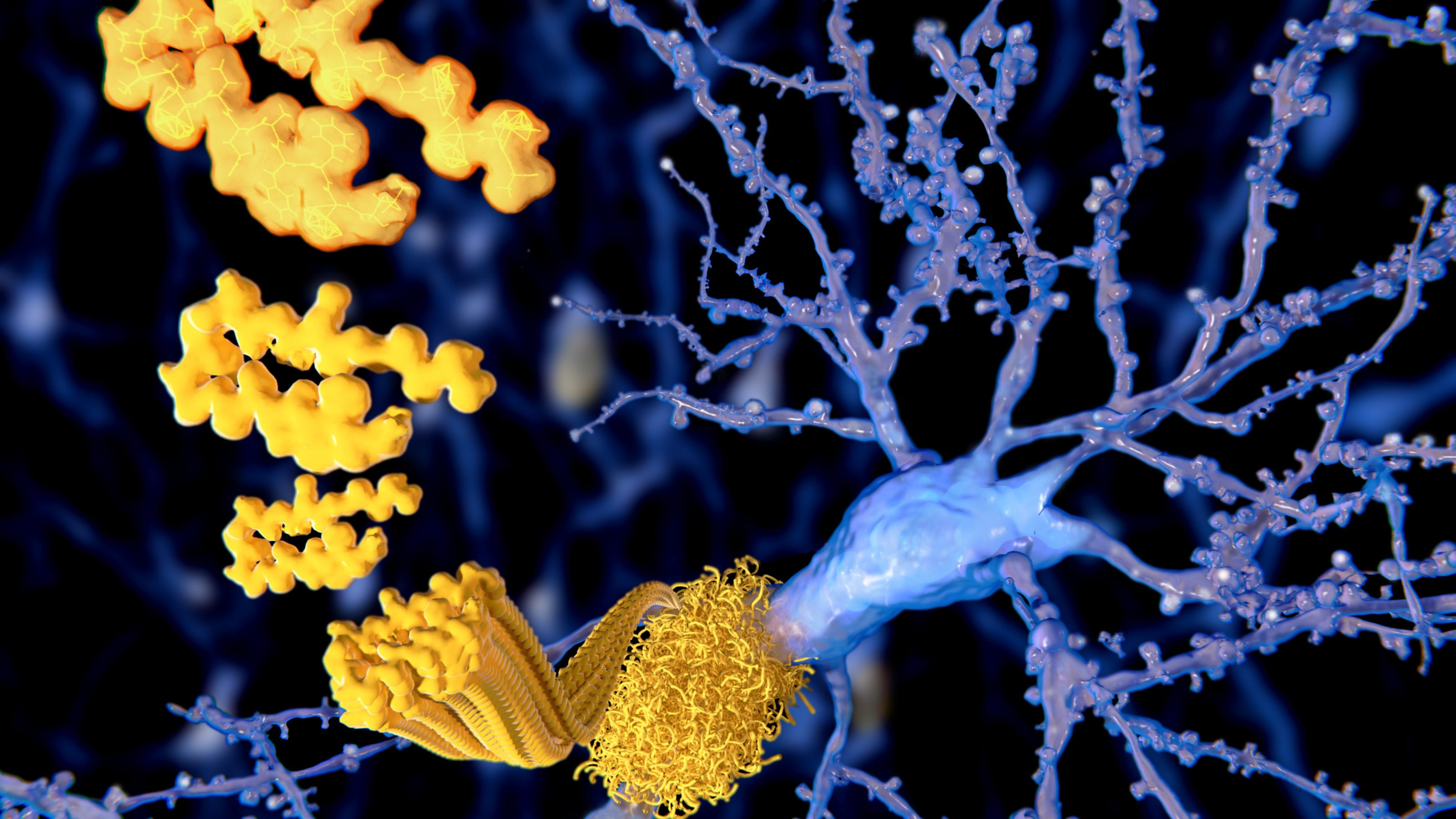 Computerillustration eines Amyloid-Beta-Peptids. Lilafarbene Verzweigung mit gelben Klumpen. . Dieses Protein ist der Hauptbestandteil von Amyloid-Plaques im Gehirn von Alzheimer-Patienten.
