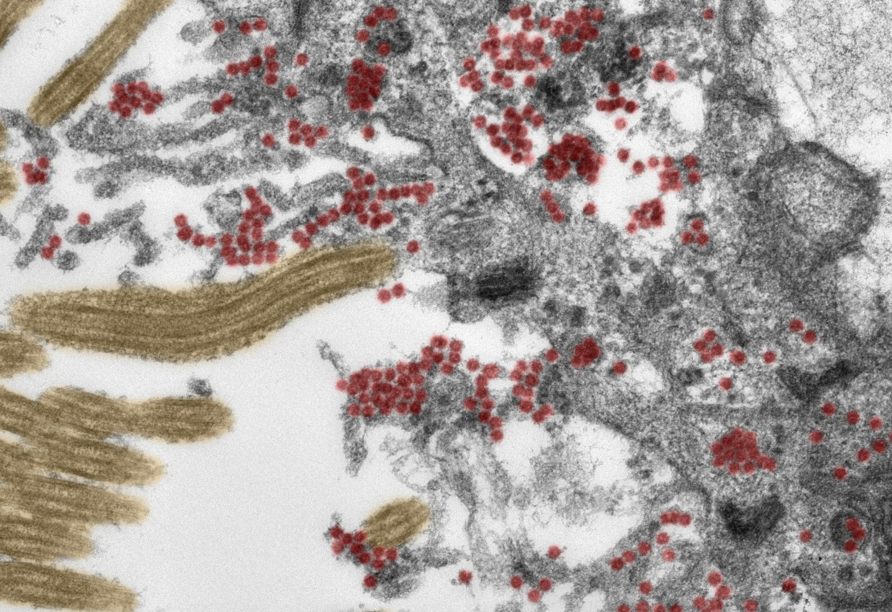 Die elektronenmikroskopische Aufnahme (Ultradünnschnitt, koloriert) zeigt den Ausschnitt einer Zelle in der Riechschleimhaut. Sowohl innerhalb der Zelle als auch auf den Zellfortsätzen findet sich eine große Zahl intakter SARS-CoV-2-Partikel (rot). Gelb: Flimmerhärchen.