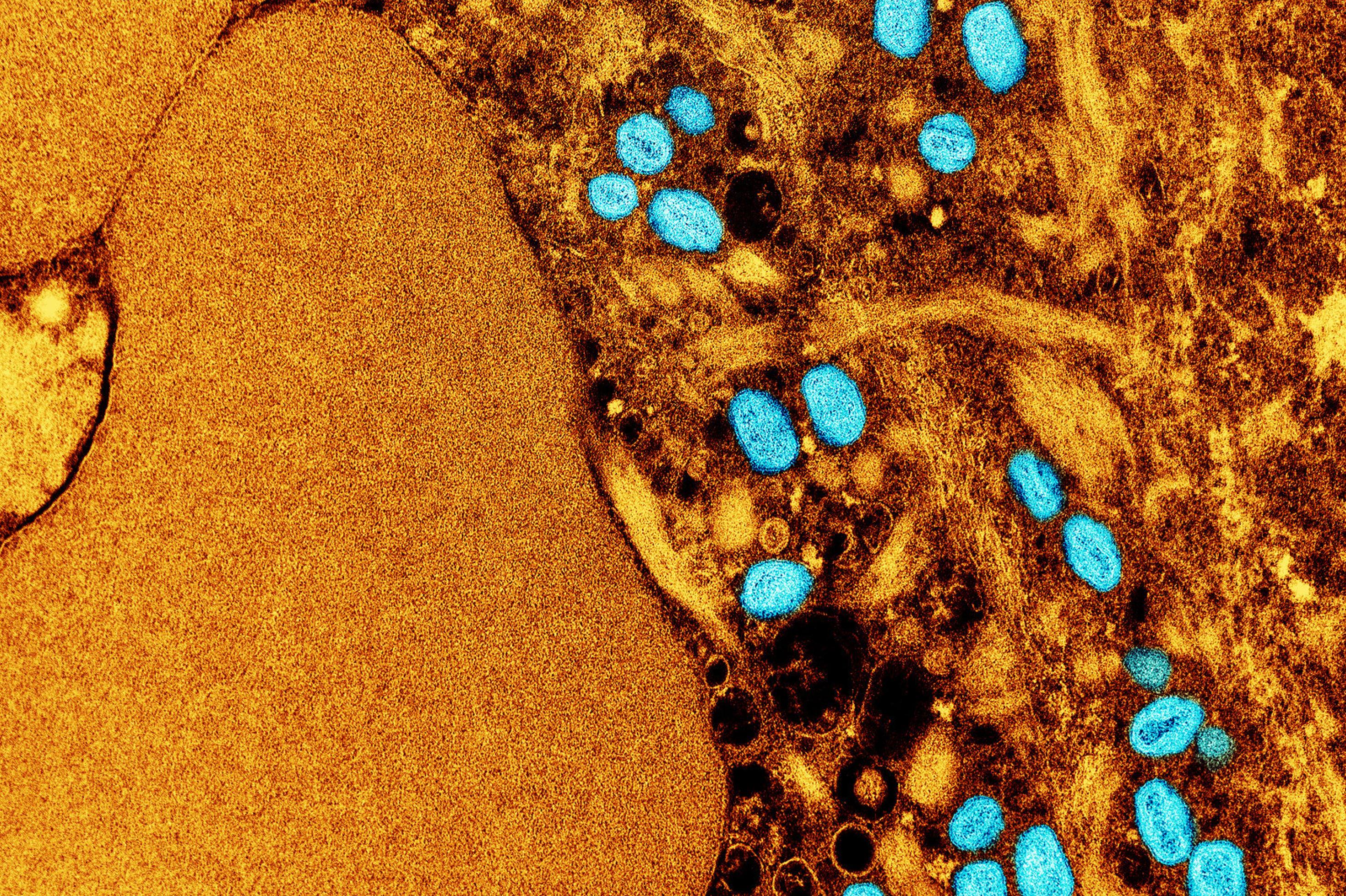 Das Foto zeigt eine elektronenmikroskopische Aufnahme von Affenpocken-Viren. Die Viren sind türkis-blau angefärbt, das infizierte Gewebe darum hellbraun.