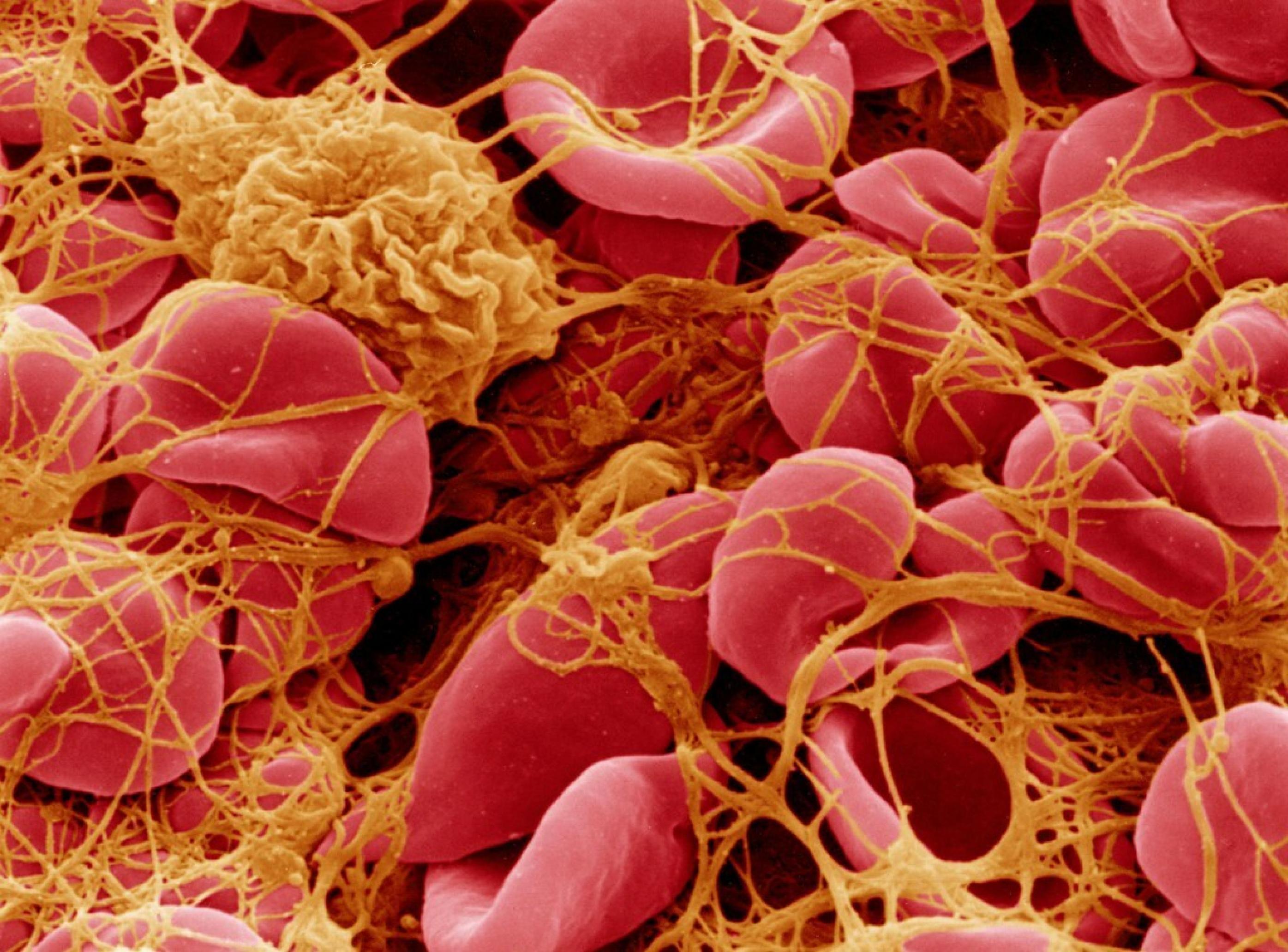 Eine elektronenmikroskopische Aufnahme von roten Blutzellen, die durch lange Fibrinfäden, welche von Thrombozyten freigesetzt werden, verklumpt sind.