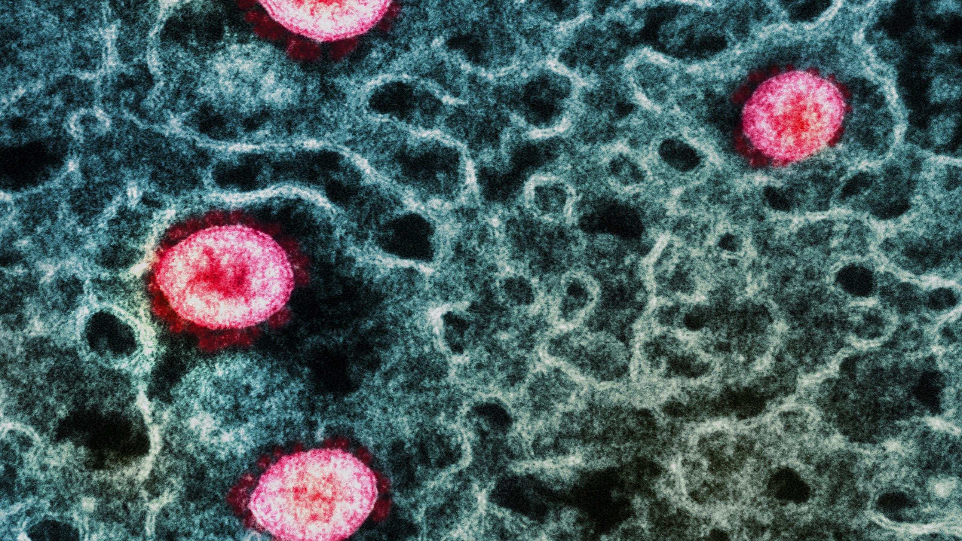 Elektronenmikroskopische Aufnahme von Sars-CoV-2, Omikron – einzelne Viruspartikel sind pink gefärbt – das sich Inneren einer Zelle aufhält.