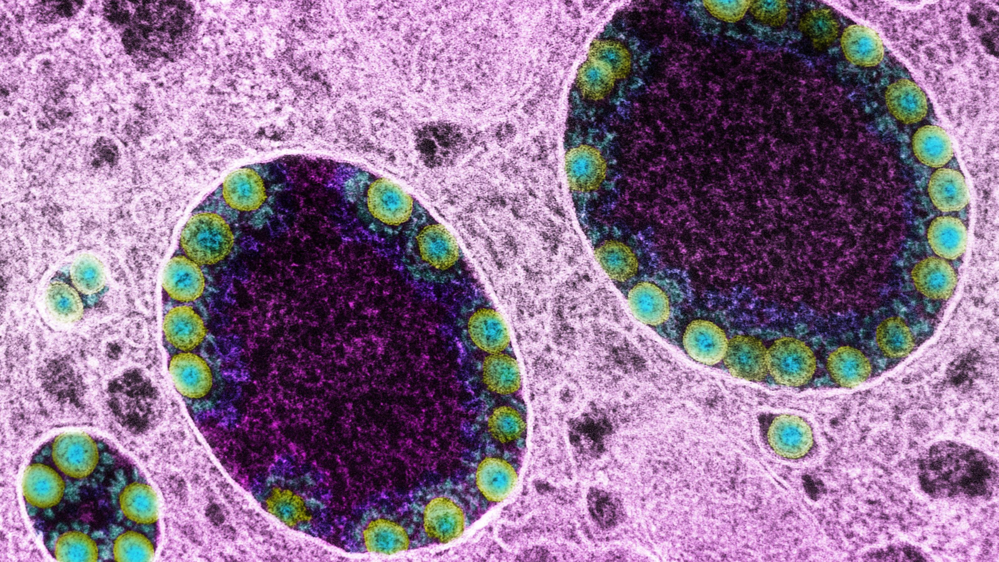 Das Bild zeigt eine rasterelektronenmikroskopische Aufnahme von grün angefärbten Sars-CoV-2 Virus-Partikeln in den Zellen der Nasenschleimhaut.