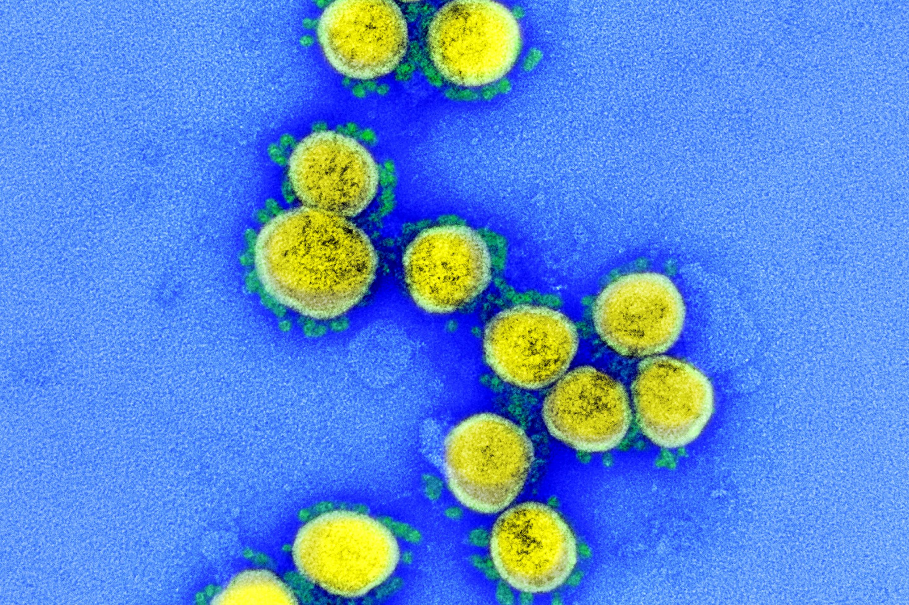 Das Foto zeigt eine elektronenmikroskopische Aufnahme des Coronavirus Sars-CoV-2. Das Virus ist gelb, seine Stacheln grün angefärbt.