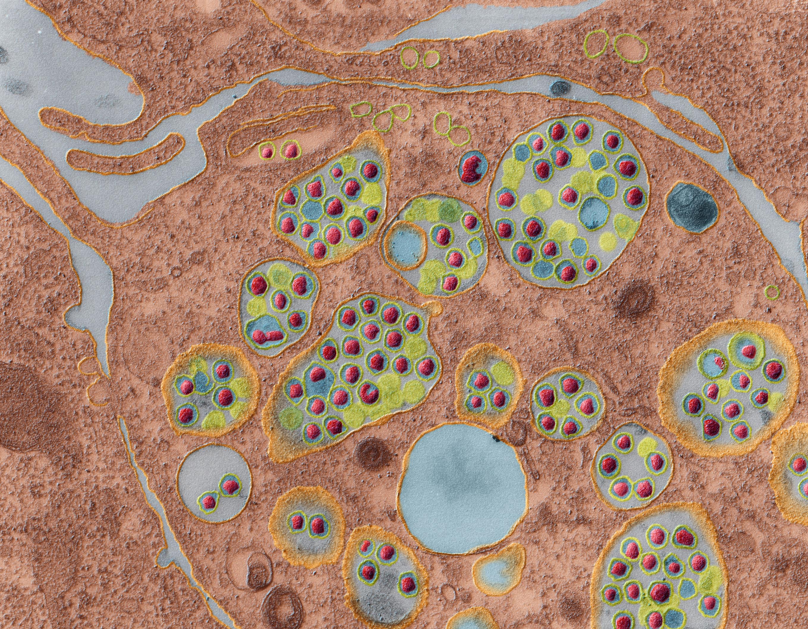 Viren: Corona-Viren entwickeln sich innerhalb einer Zelle.
Corona-Viren gehören zu den grössten RNA-Viren. Sie besitzen ein virales Einzelstrang-RNA-Molekül, das mit einem Kapsid-Protein zusammen den Proteinkomplex bildet. Corona-Viren erzeugen bei Mensch und Tier respiratorische und gastrointestinale Erkrankungen. Ca 25% der banalen respiratorischen Erkrankungen werden durch Corona-Viren beim Menschen hervorgerufen. Das neuartige Coronavirus (2019-nCoV) gehört wie das SARS-Virus zu den beta-Coronaviren. SARS: severe acute respiratory Syndrom ( schweres Atemwegssyndrom unbekannter Herkunft)
Krankheitsbild bei Infektionen mit dem Coronavirus: Hohes Fieber, Atembeschwerden, Husten, Lungenentzündung. Mögliche Übertragung durch Tröpfchen- oder Schmierinfektion. Inkubationszeit: 2–5 Tage
Keine dauerhafte Immunisierung, keine Impfung möglich.
Raster-Elektronenmikroskop, 24.000:1 (bei 15×12 cm Bildgrösse)