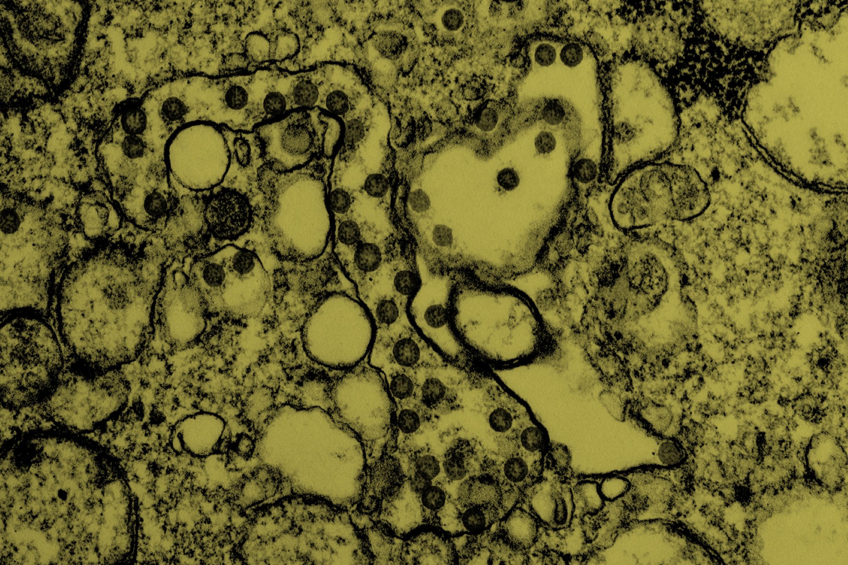 Zu sehen ist eine Nahaufnahme einer Gewebeprobe, in der kleine Kügelchen liegen. Dabei handelt es sich um die farblich hervorgehobenen Viren.