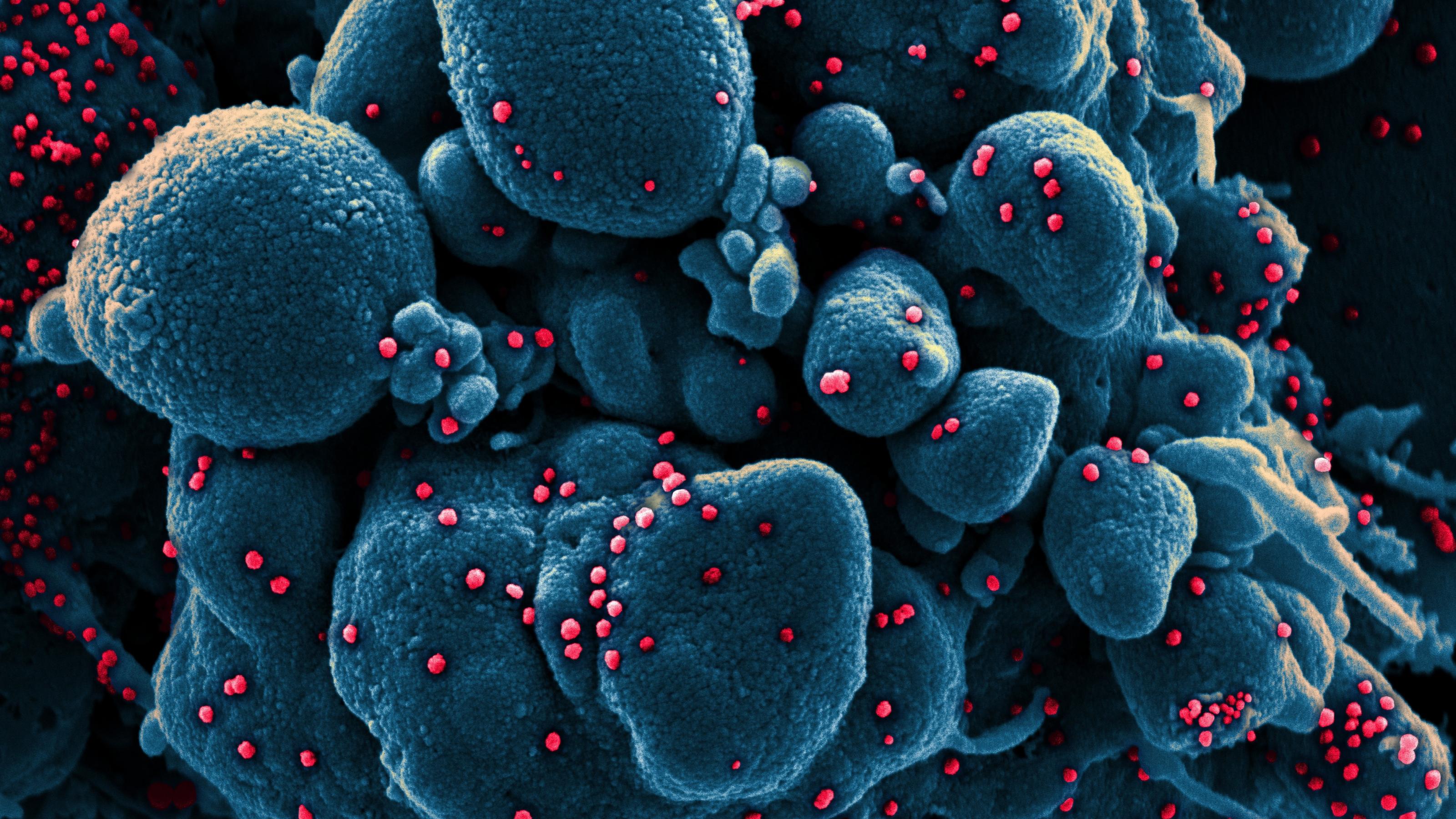 Ein Gewebe mit mehreren kugeligen dunkelblau eingefärbten Körperzellen. Darauf sitzen an mehreren Stellen kleine pinkfarbene Kügelchen. Dabei handelt es sich um das neue Coronavirus.