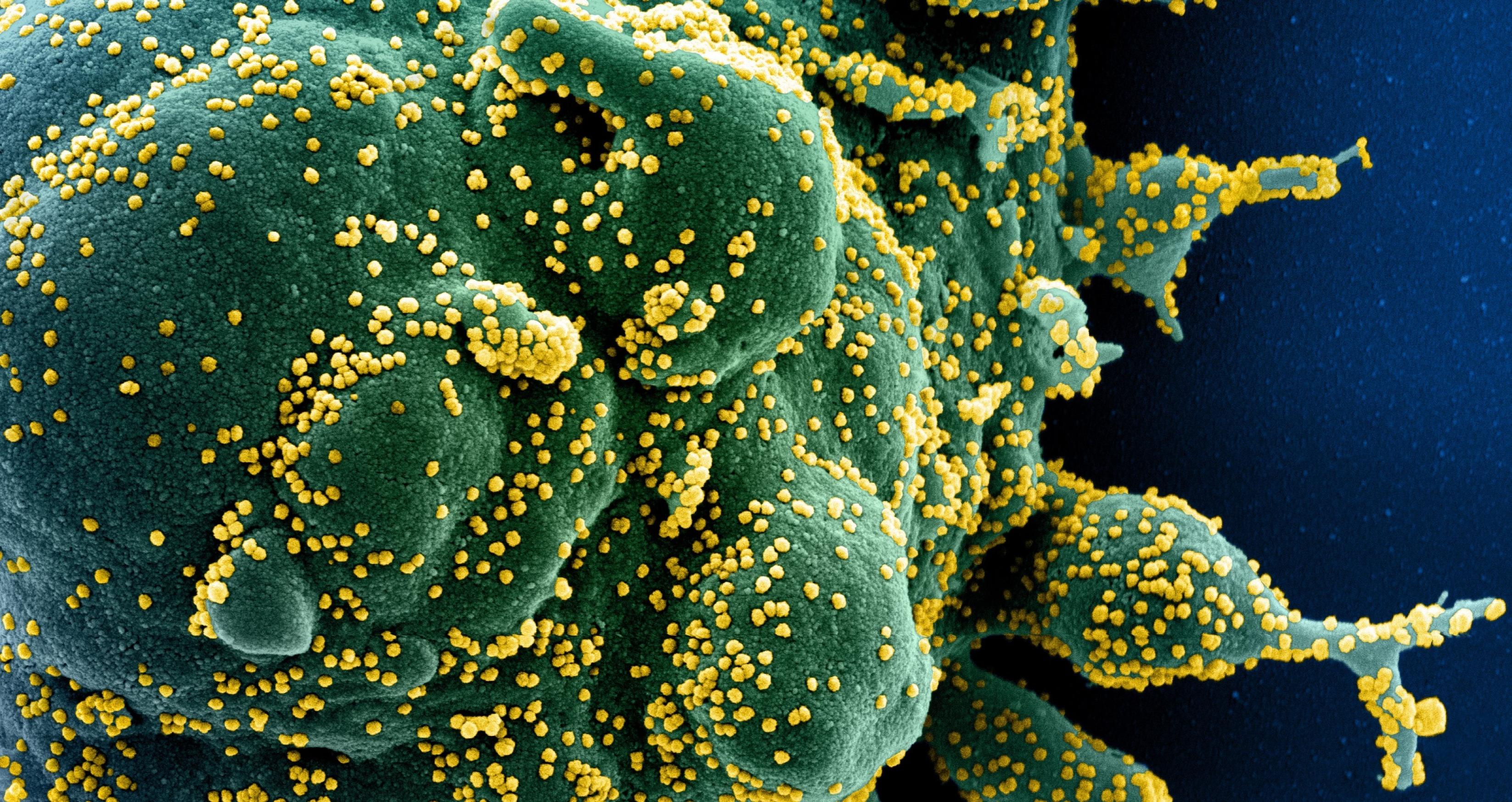 Mehrere menschliche Zellen mit einer zottigen Oberfläche. Darauf sitzen kleine gelb eingefärbte Viren.