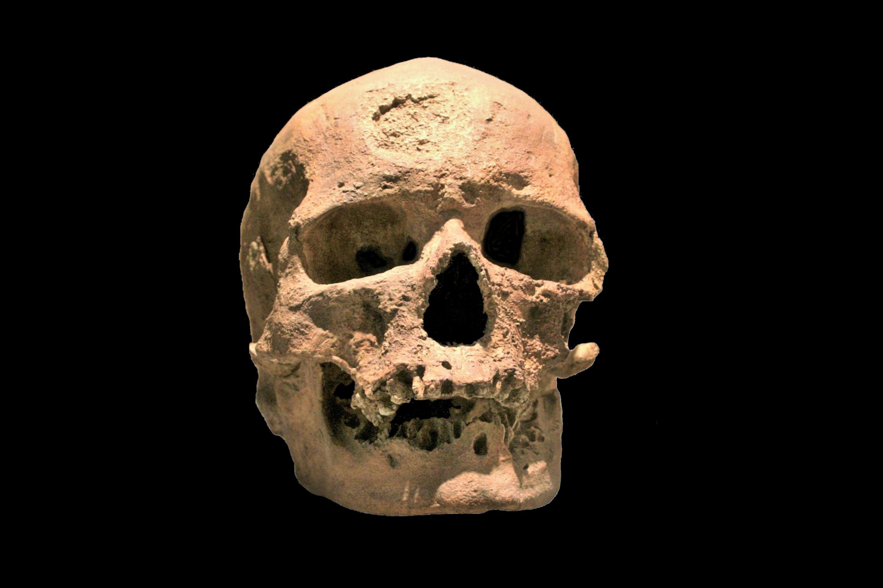 Das Foto zeigt von vorne den gelblichen Schädel eines alten, zahnlosen Mannes vor schwarzem Hintergrund. Die Stirn ist hoch gewölbt, über den Augen sind keine Verdickungen zu erkennen, der Unterkiefer ist eher klein.