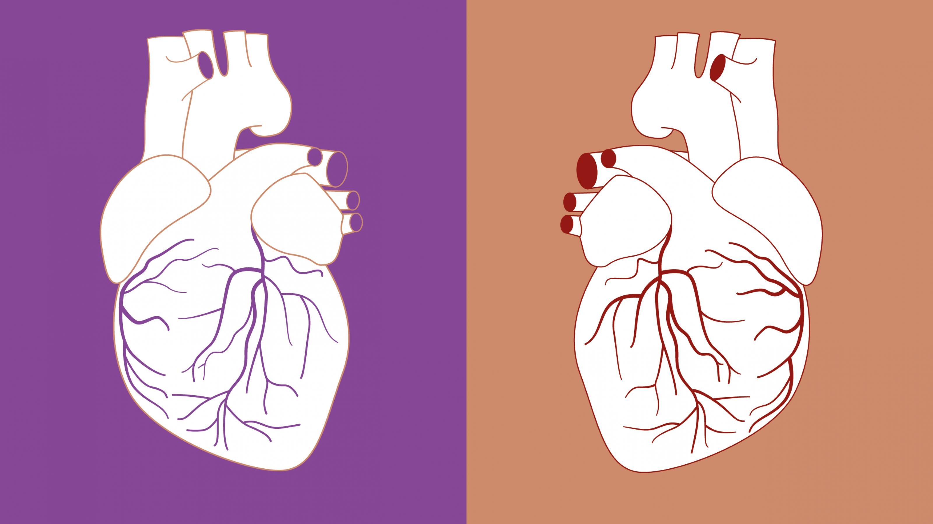 Das Bild ist in eine linke und eine rechte Hälfte geteilt. Links ist eine Zeichnung eines menschlichen Herzens vor einem lila Hintergrund zu sehen. Rechts ist die gleiche Zeichnung spiegelverkehrt vor einem beigen Hintergrund zu sehen.