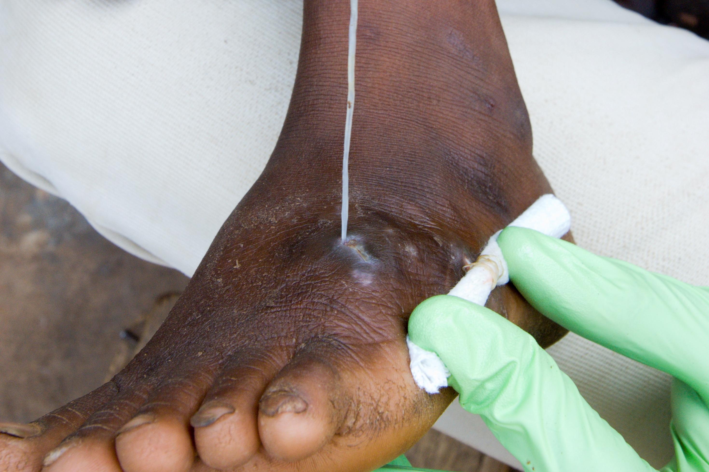 Ein Fuß, aus dem ein langer weißer Guineawurm gezogen und dabei aufgewickelt wird.
