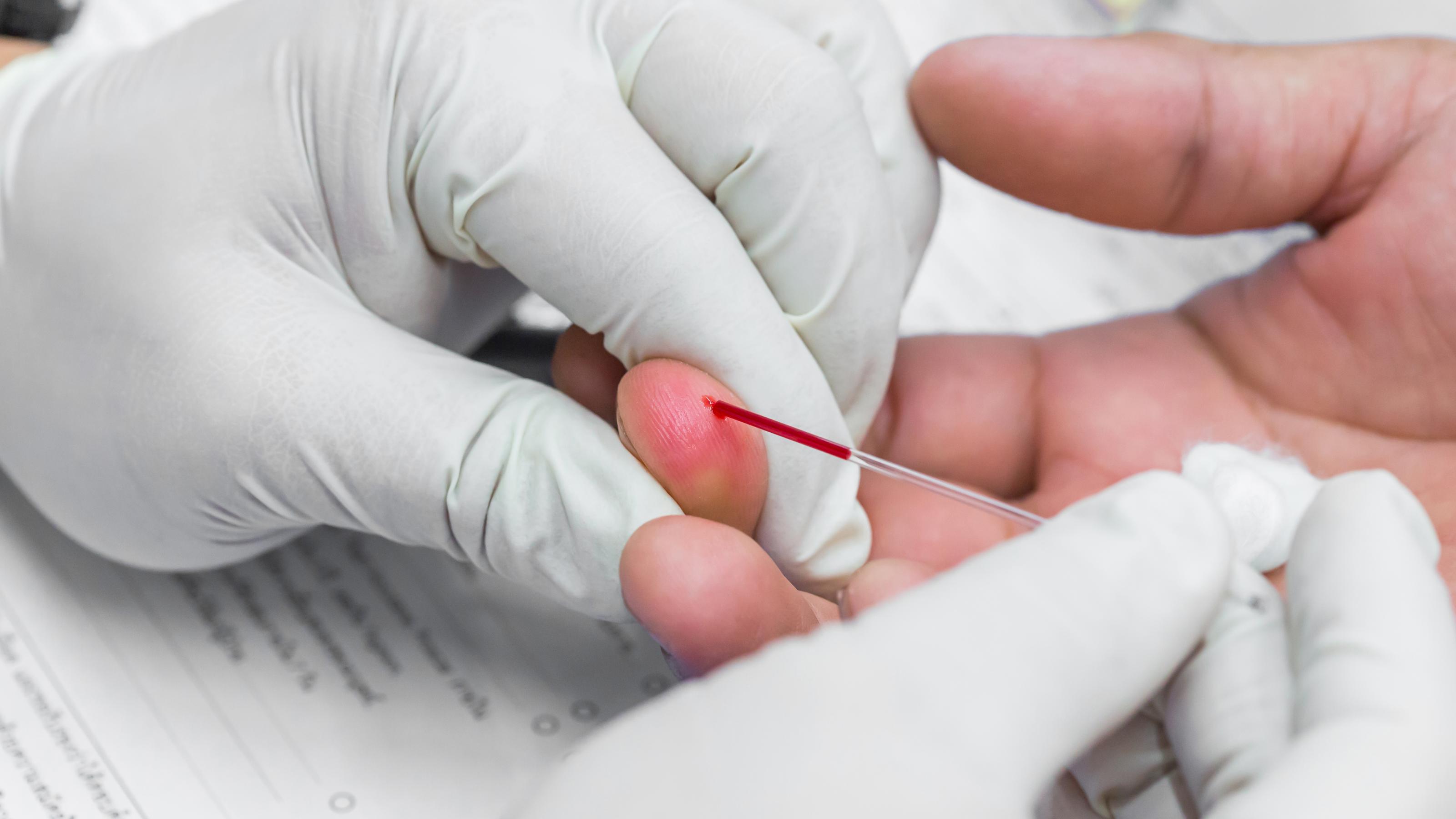 Eine medizinische Fachperson mit weißen Handschuhen entnimmt bei einer anderen Person aus dem Finger einen Bluttropfen mithilfe eines Kapillarröhrchens.