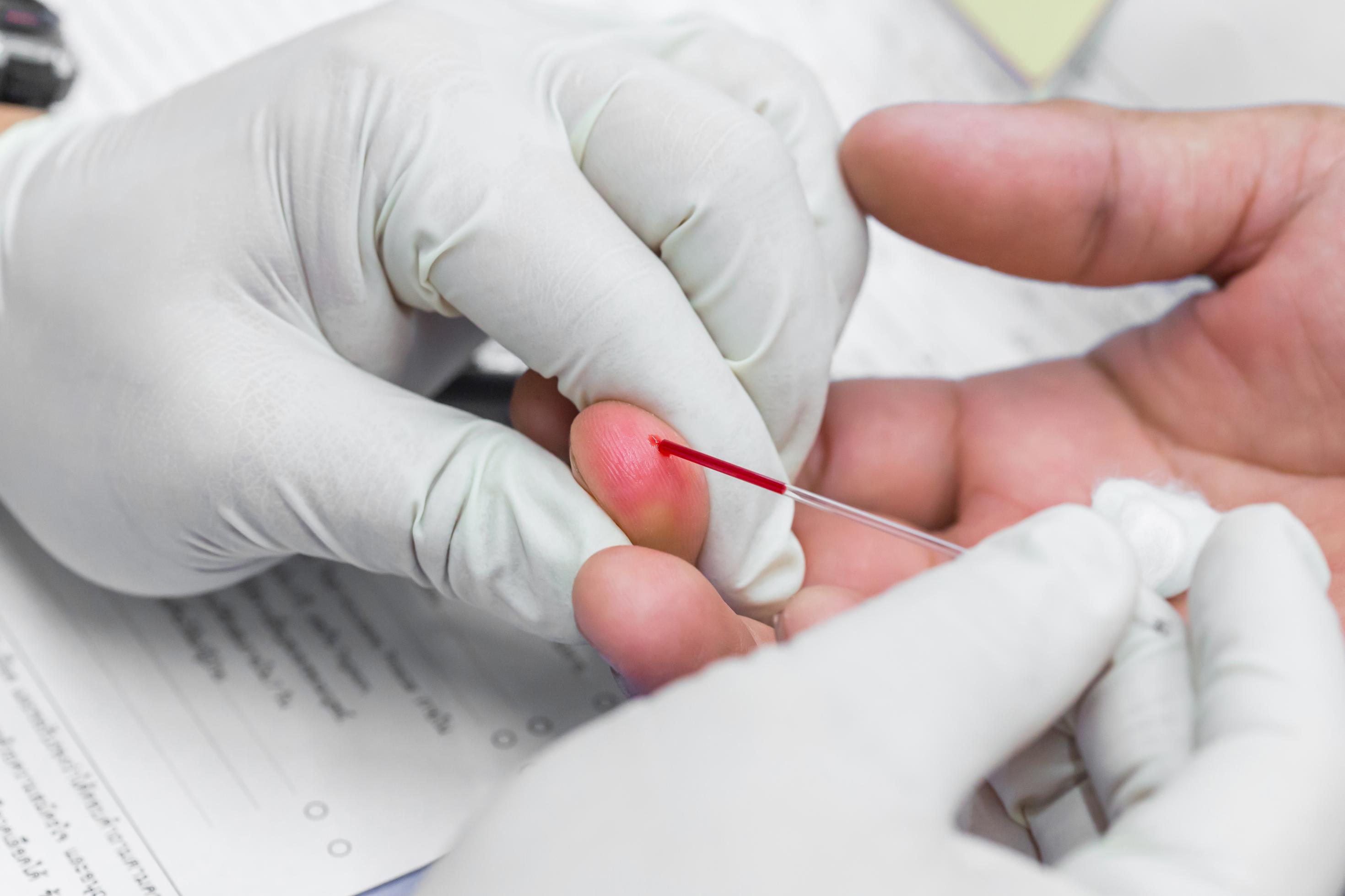 Eine medizinische Fachperson mit weißen Handschuhen entnimmt bei einer anderen Person aus dem Finger einen Bluttropfen mithilfe eines Kapillarröhrchens.