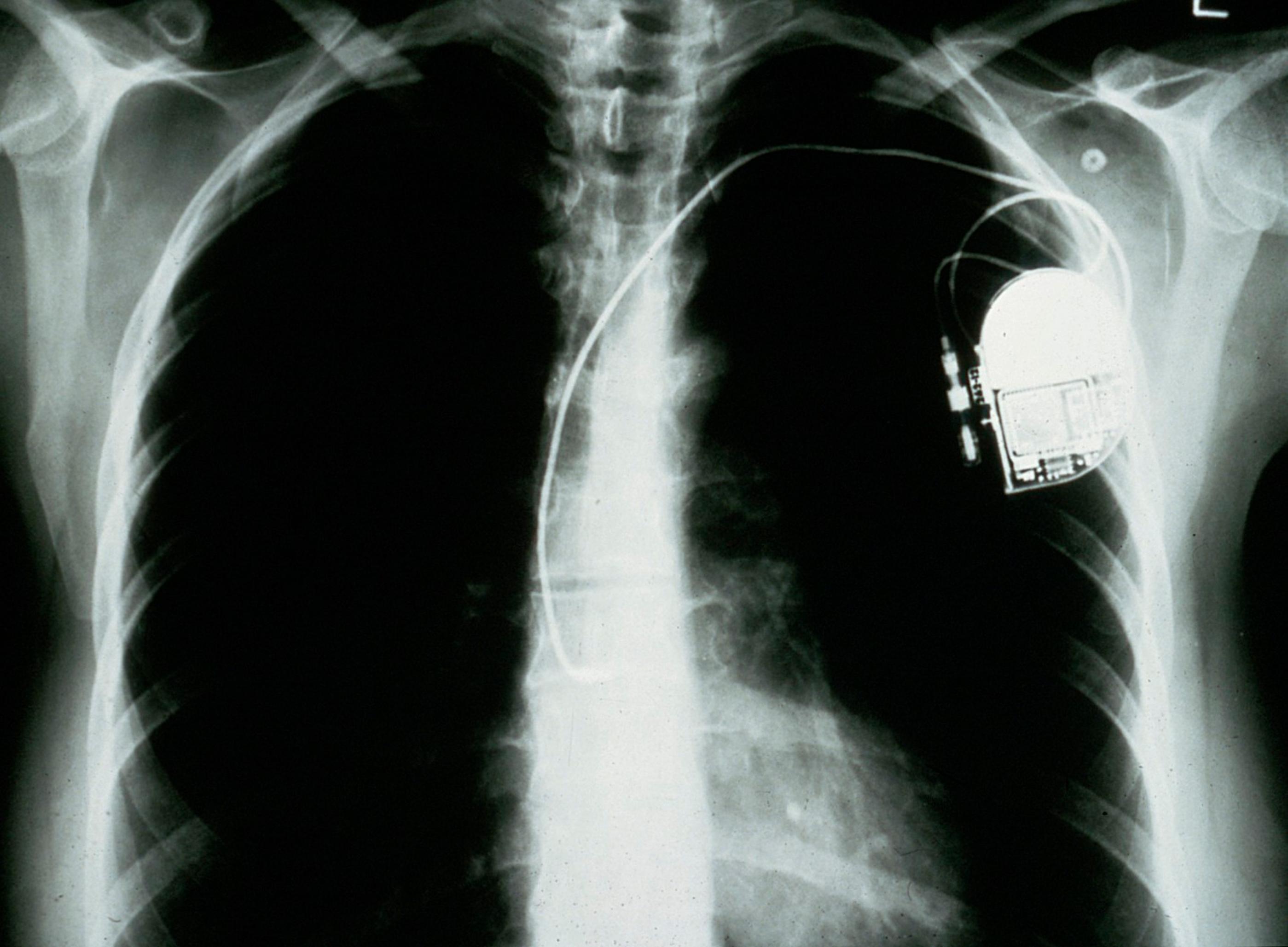 Röntgenbild mit implantiertem Herzschrittmacher