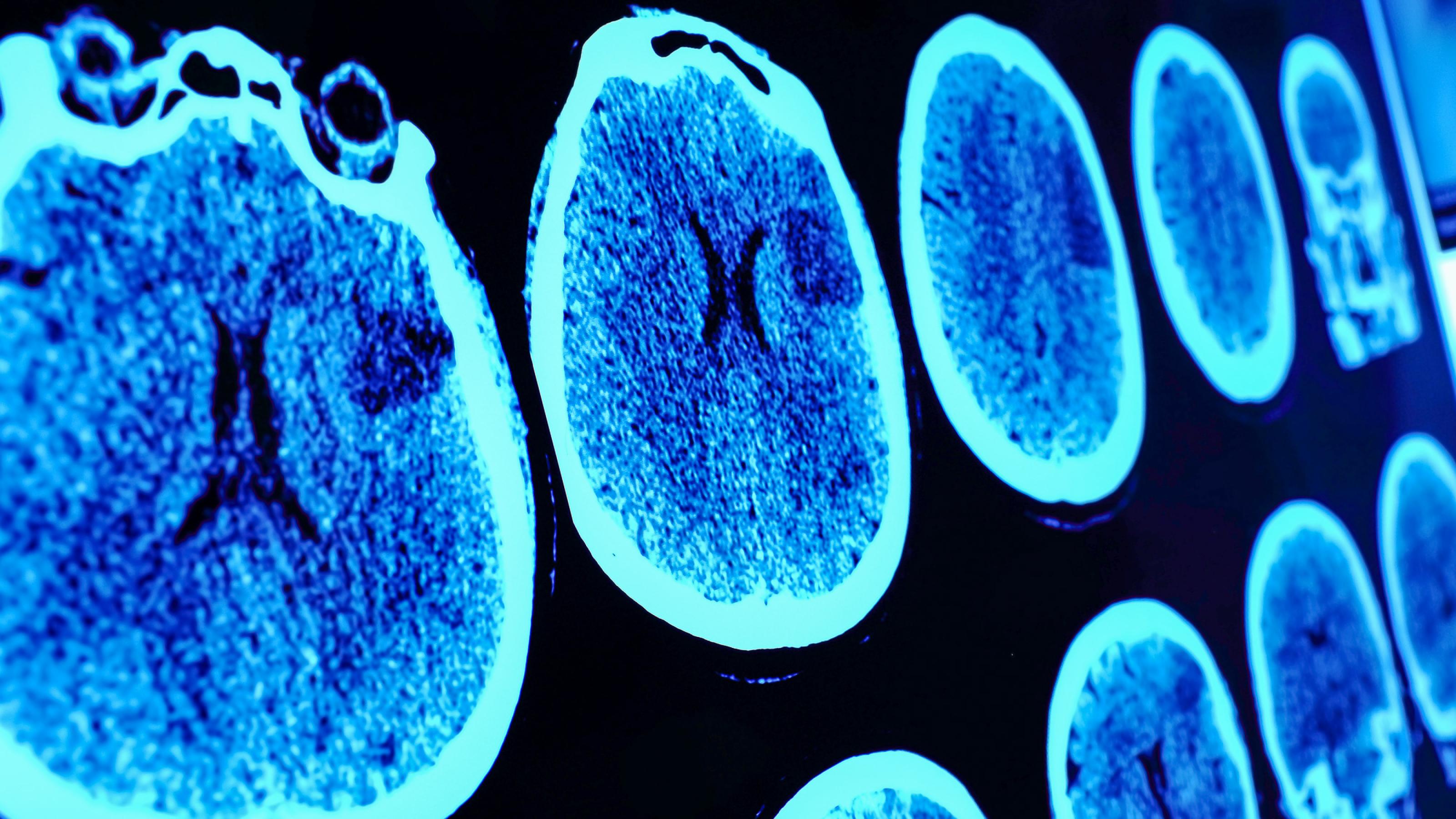 Röntgenaufnahmen eines menschlichen Gehirns hängen an einem Leutapparat.
