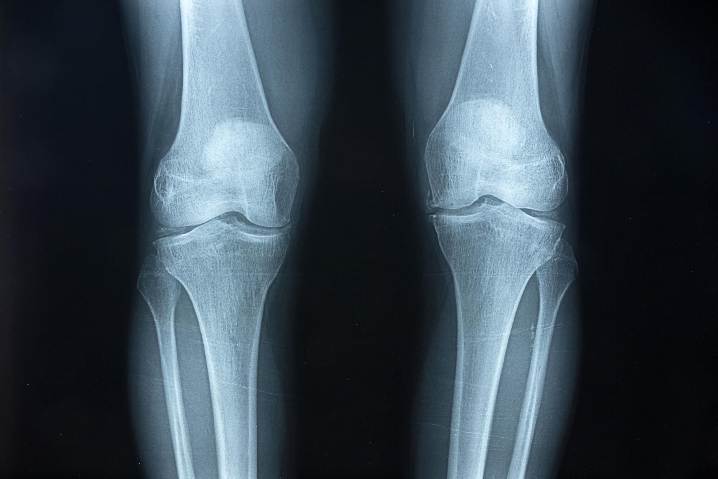 Das schwarzweiße Röntgenbild zeigt die beiden massiven Kniegelenke eines heutigen Menschen und jeweils ein Stück der Oberschenkelknochen sowie der Unterschenkel. Die Knochen im Gelenk stehen etwas schräg aufeinander, weil das Becken beim aufrecht gehenden Menschen breiter ist als bei Affen. So lässt sich auch an fossilen Knochen erkennen, ob sich ein Lebewesen einst zweibeinig fortbewegt hat.