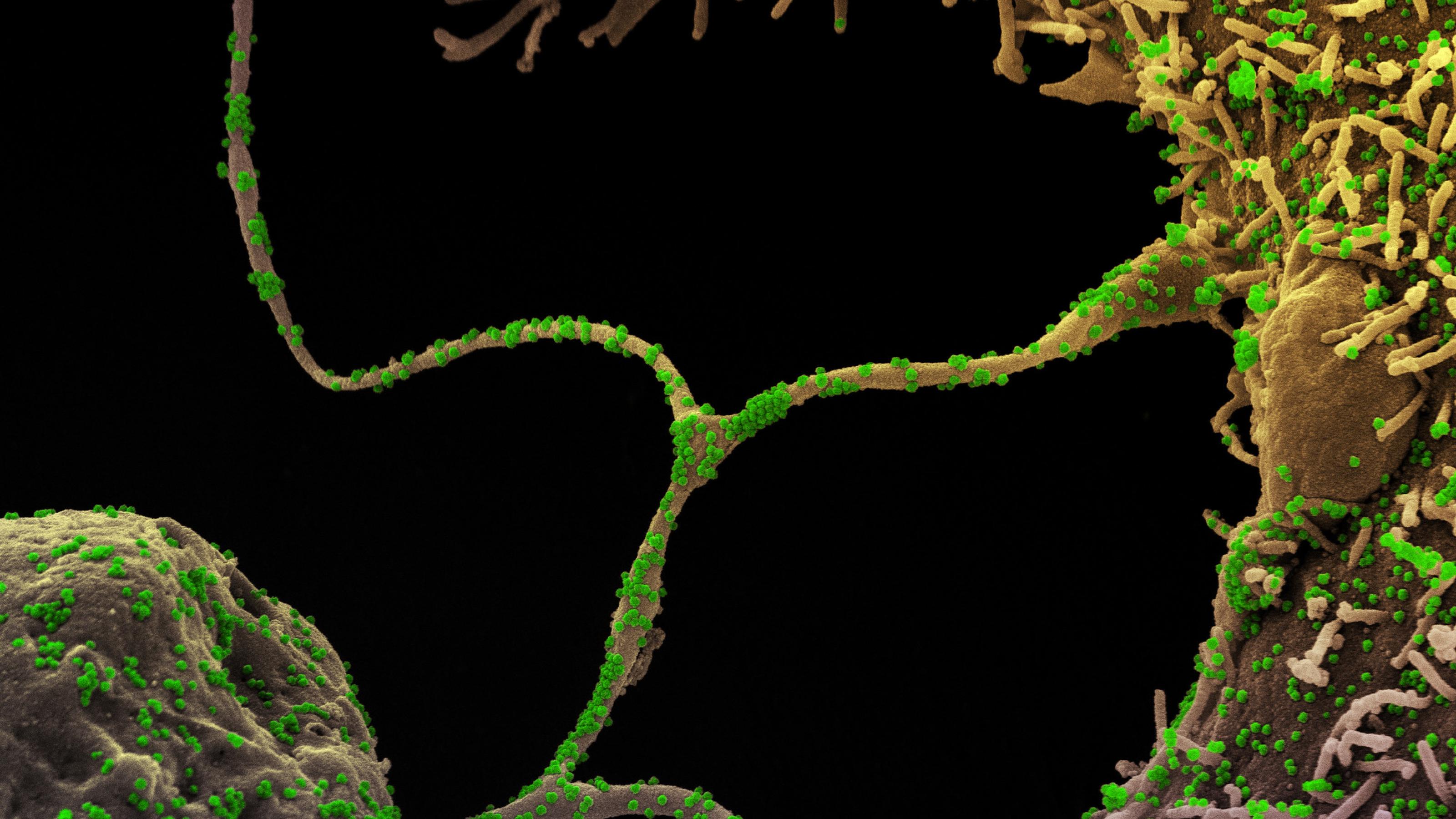 Das Foto zeigt eine elektronenmikroskopische Aufnahme von Coronaviren (grün) die Körperzellen (grau) infizieren.