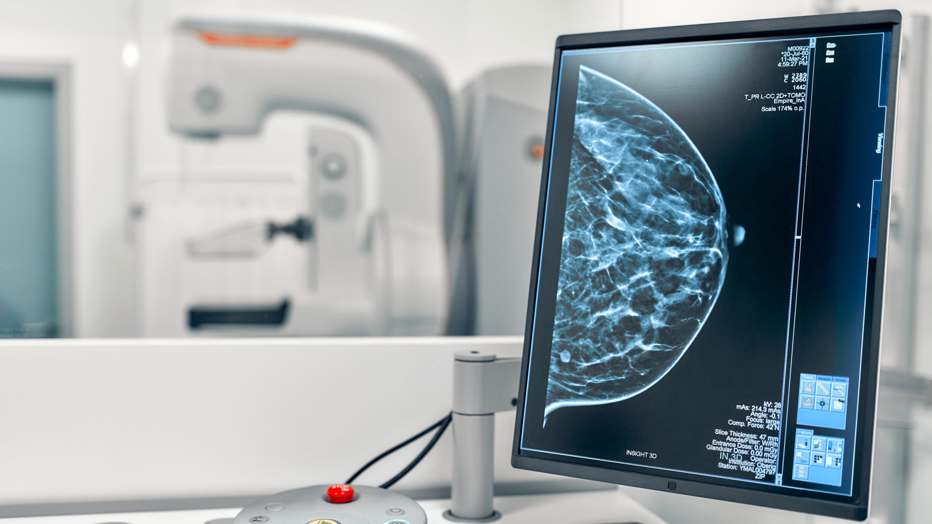 Im Hintergrund ein Röntgengerät, im Vordergrund ein Monitor mit Röntgenbild einer weiblichen Brust