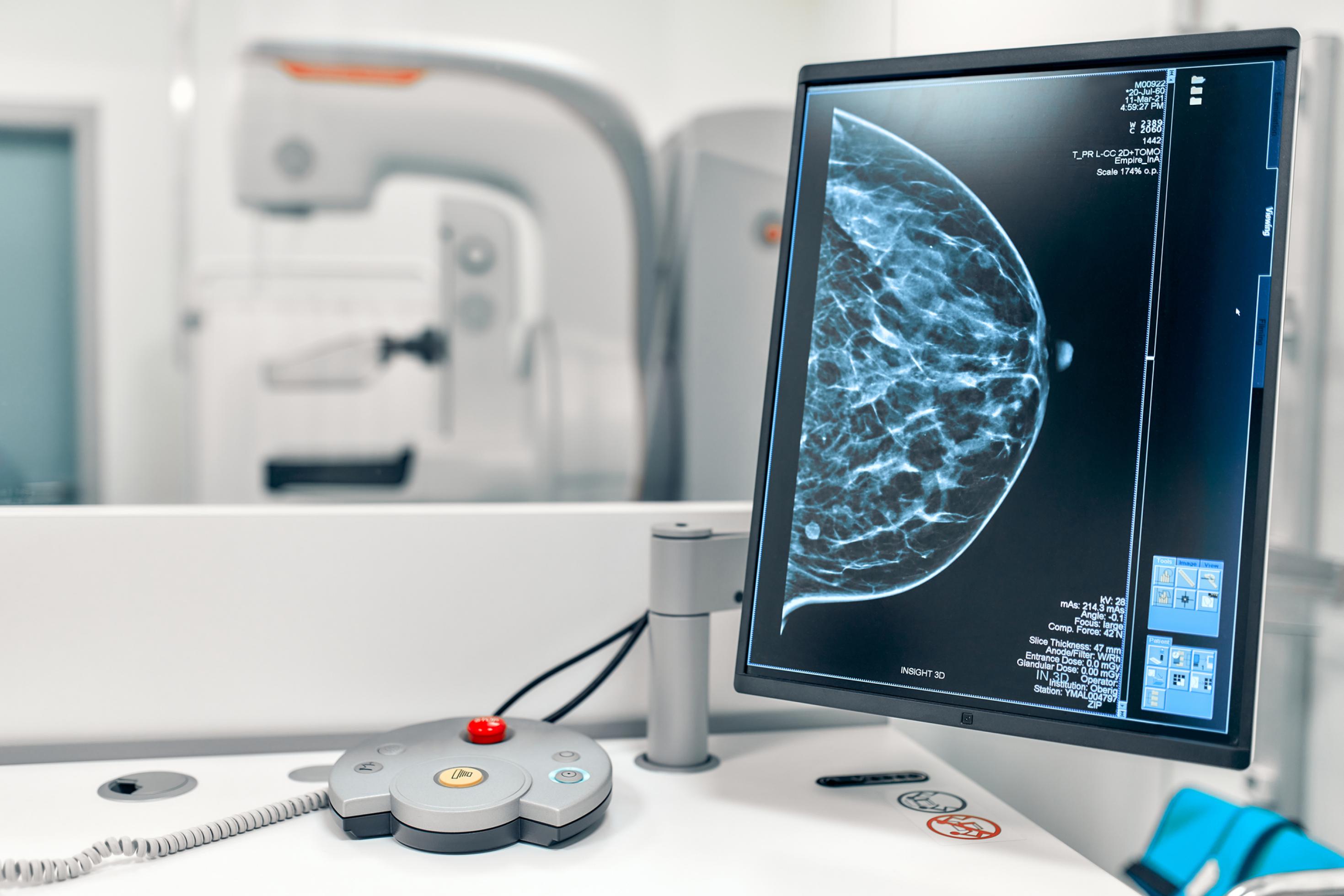 Im Hintergrund ein Röntgengerät, im Vordergrund ein Monitor mit Röntgenbild einer weiblichen Brust