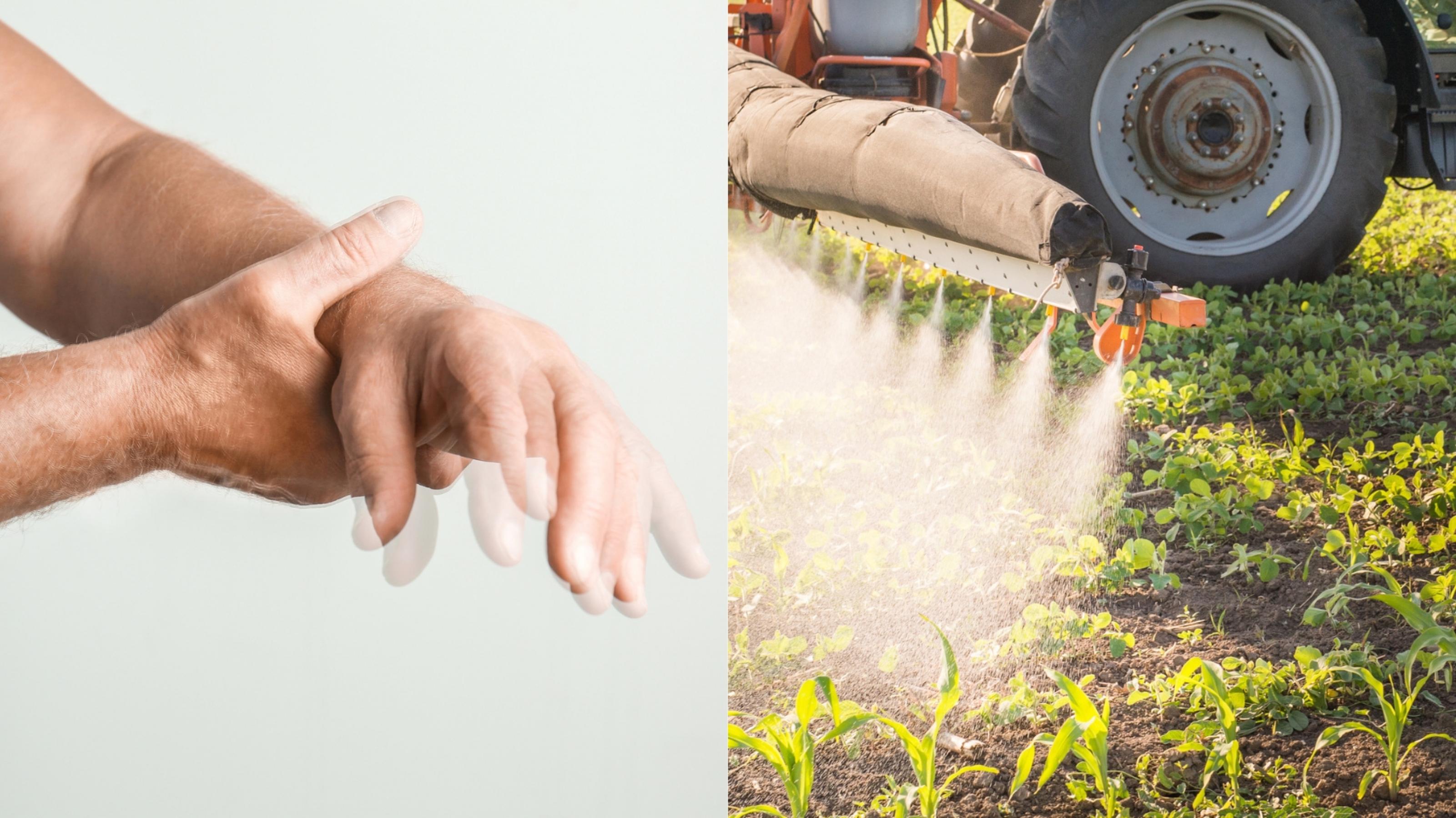 Montage aus zwei Bildern. Linkes Foto: eine Hand eines Mannes, der einen Tremor hat. Rechtes Foto: Sprühdüsen, die auf dem Feld Pestizide ausbringen.