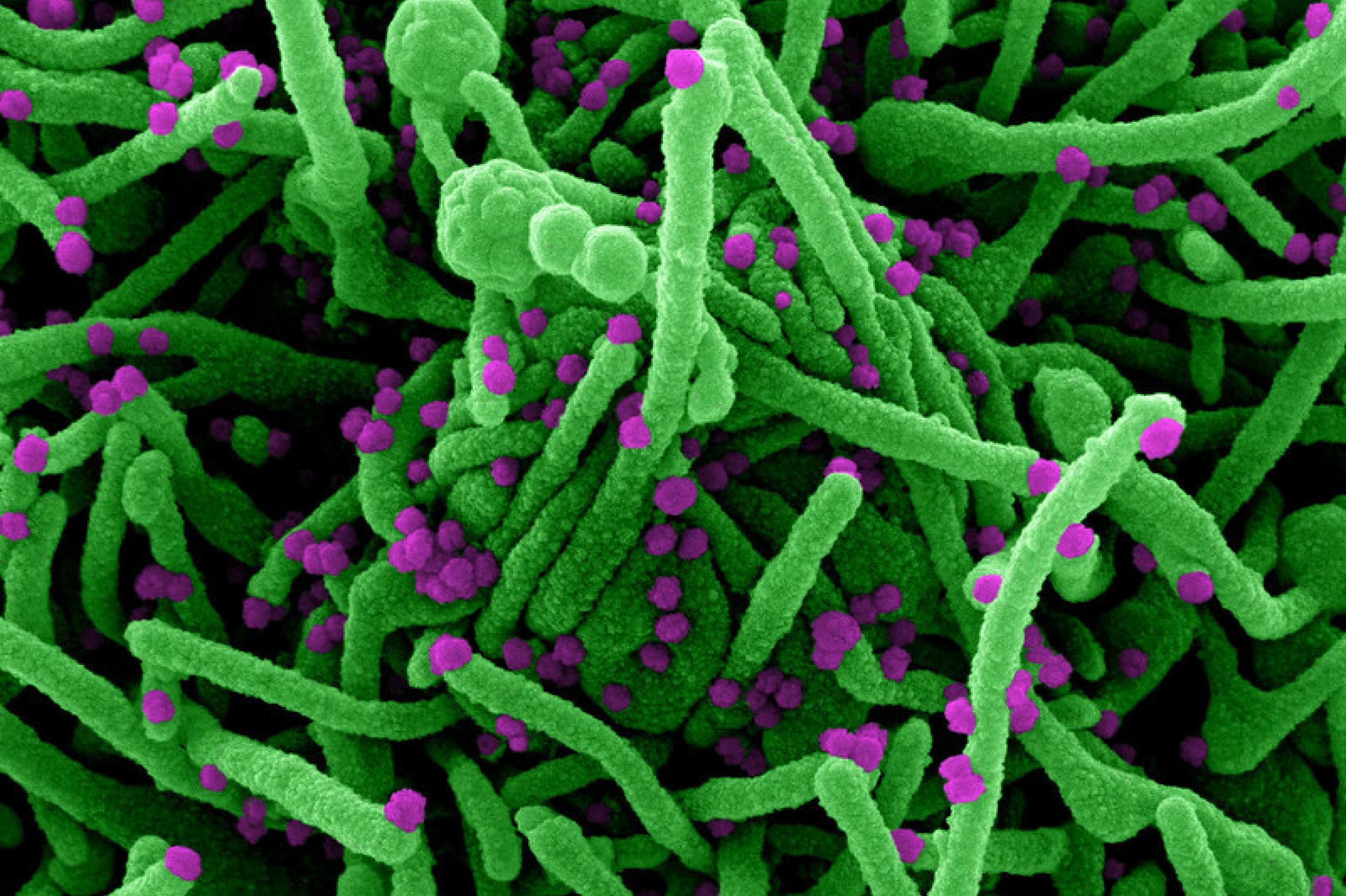 Das Foto zeigt eine elektronenmikroskopische Aufnahme von menschlichen Zellen, die hier grün angefärbt sind, mit Sars-CoV-2 (violett angefärbt).