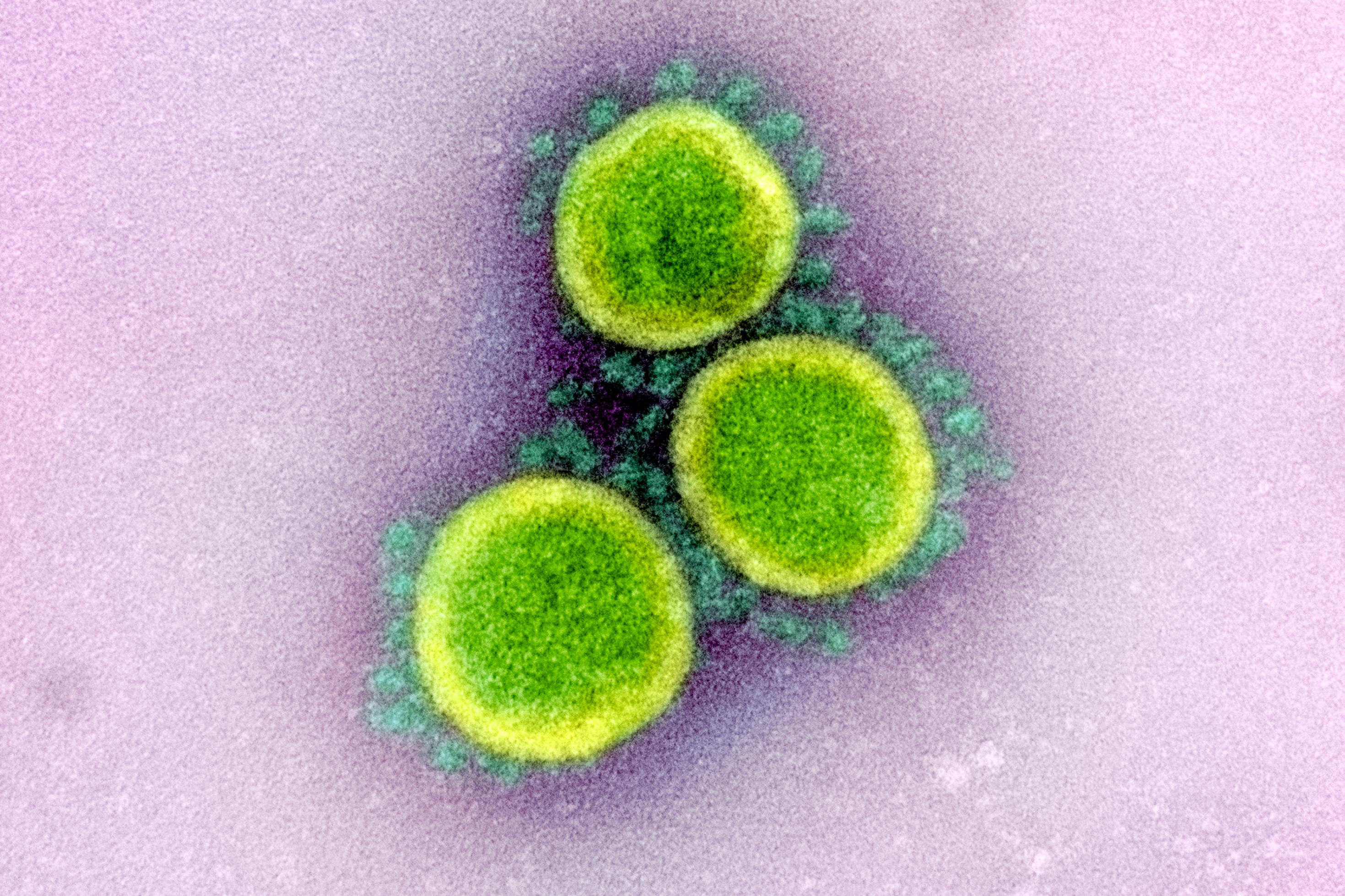 Rasterelektronenmikroskopische Aufnahme von Sars-CoV-2; das Virus ist in hellgrün, seine stacheligen Hüllproteine, die Spike-Proteine, in dunkelgrün dargestellt.