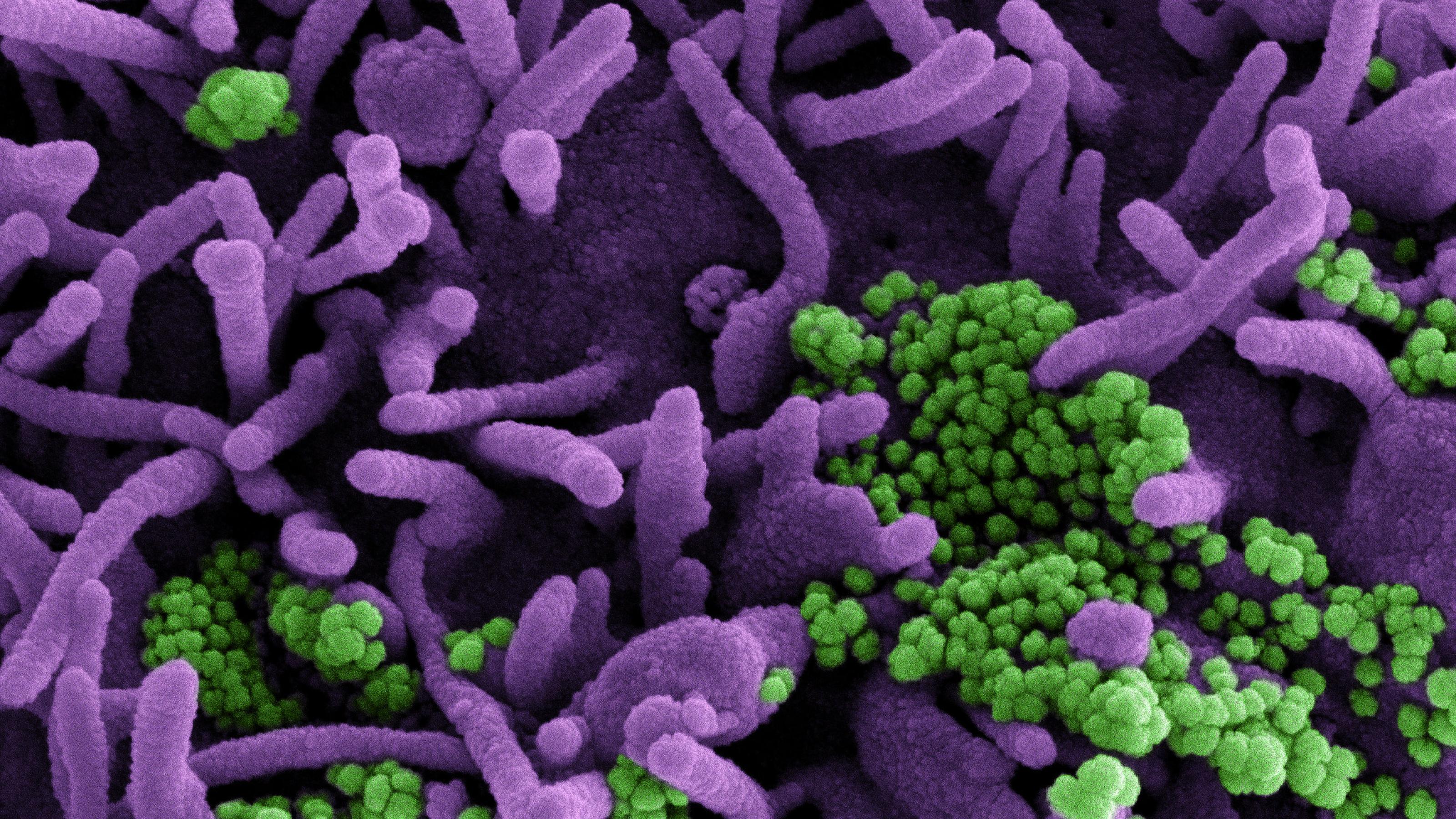 Das Coronavirus Sars-CoV-2 in einer elektronenmikroskopischen Aufnahme: Viruspartikel grün angefärbt, infizierte Zelle violett angefärbt.