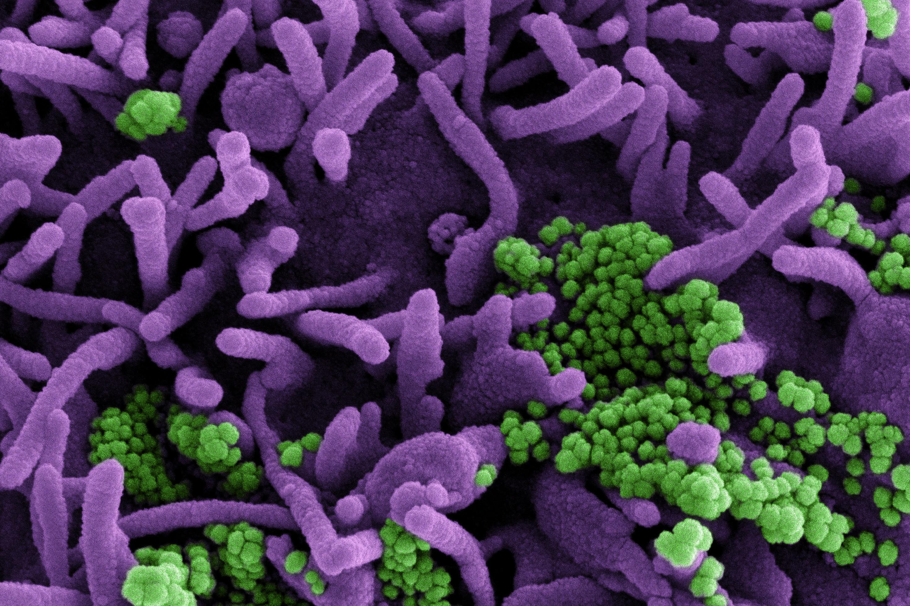Das Coronavirus Sars-CoV-2 in einer elektronenmikroskopischen Aufnahme: Viruspartikel grün angefärbt, infizierte Zelle violett angefärbt.