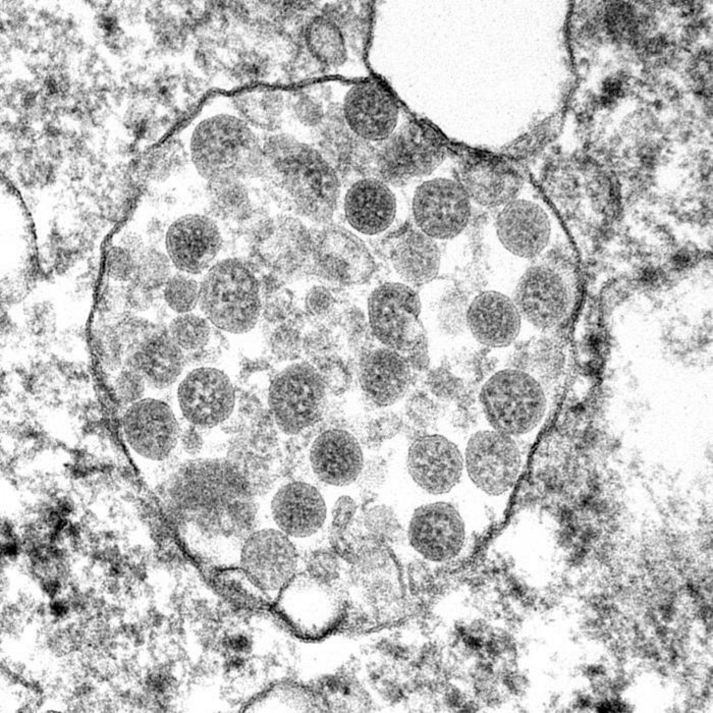 Elektronenmikroskopische Aufnahme einer mit Sars-CoV-2 infizierten Körperzelle. Zu erkennen sind die sphärischen Viruspartikel, die von der Zelle produziert worden sind.