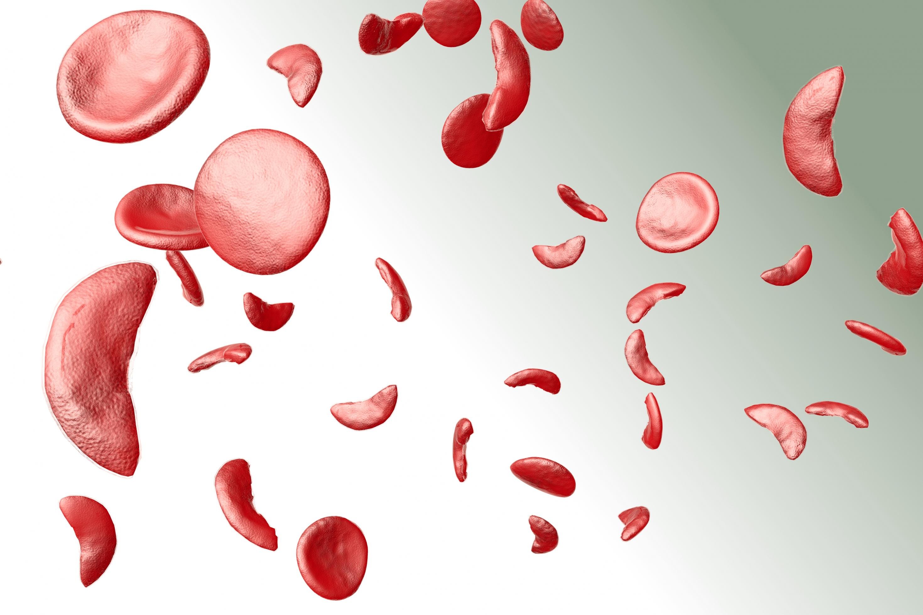 Grafische Animation der roten Blutkörperchen im menschlichen Blut. Die regulären Blutkörperchen sind eher rund, bei der Sichelzellenanämie sind sie sichelförmig. Der Unterschied ist bereits unter dem Mikroskop zu sehen.